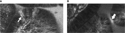 Preservation of Gastrointestinal Mucosal Barrier Function and Microbiome in Patients With Controlled HIV Infection